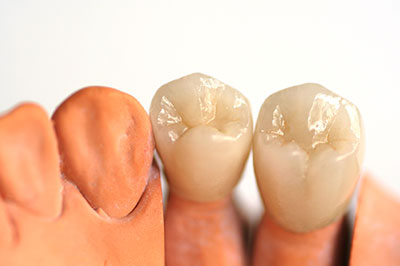 Dental Crowns in Terre Haute IN