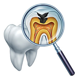 Tooth Decay Treatment in Terre Haute IN