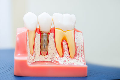 Dental Implants in Terre Haute IN