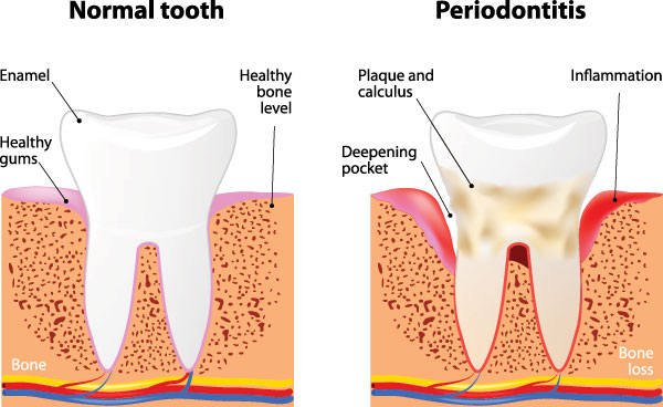 Periodontal Treatment in Terre Haute IN