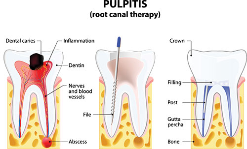 Root Canal Treatment Terre Haute IN